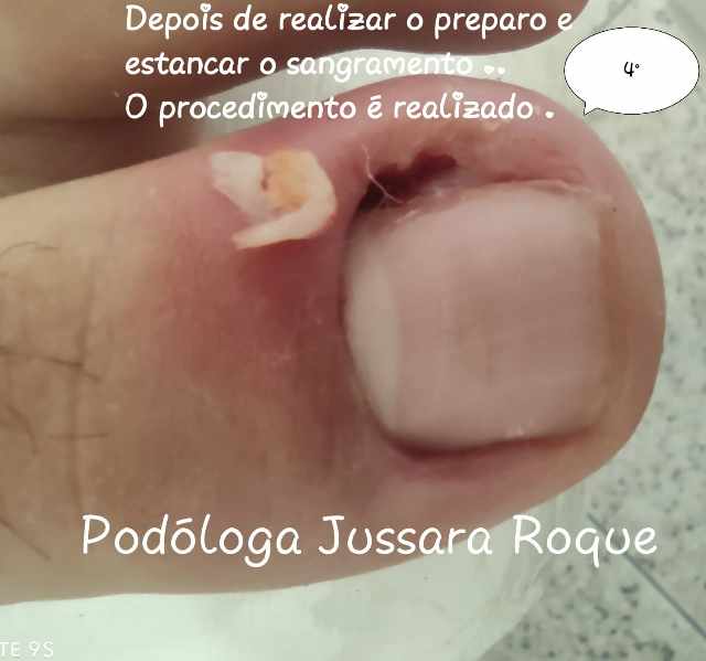 Foto 1 - Podologia Lourinh / Pedicure medical